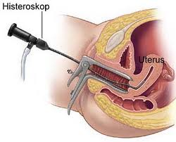 histeroskopi
